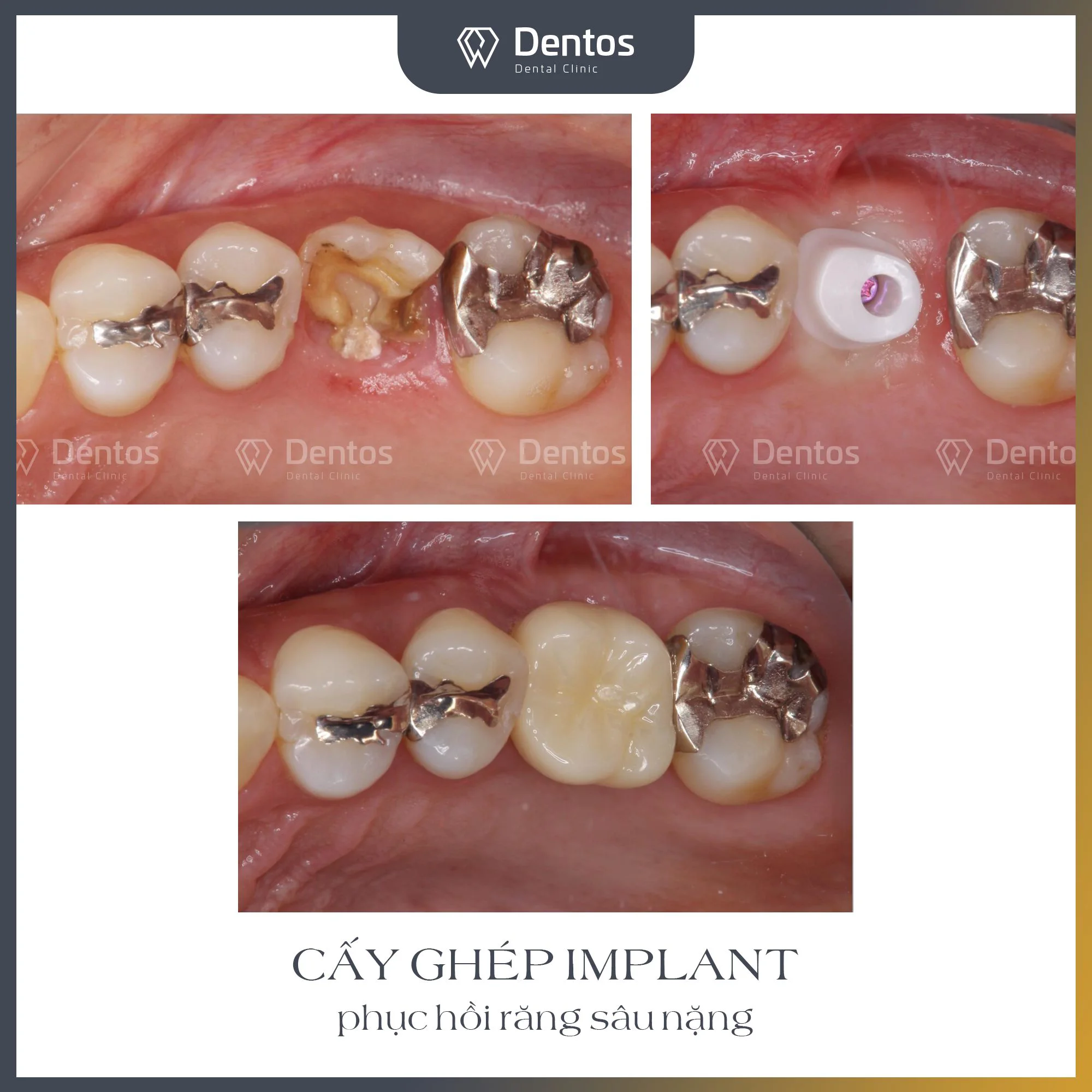Trụ implant Straumann SLA liên tục chứng minh tỷ lệ thành công vượt trội